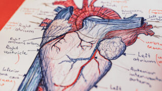 Катетерная аблация снижает риск деменции у пациентов с фибрилляцией предсердий на 48%