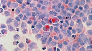 Открыт ген, вызывающий ускоренное разрастание злокачественных опухолей: новые перспективы в лечении рака