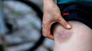 Неожиданные синяки и кровоподтеки могут быть признаком редкого заболевания крови