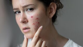 Питание против акне и розацеа: как бобовые, овощи и рыба могут помочь