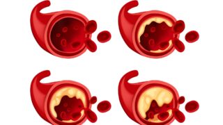Врач поделился информацией о том, какой холестерин не требует снижения