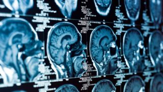 Ученые пришли к выводу, что Альцгеймера можно «подхватить» и заразиться