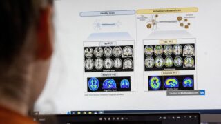 Eisai ожидает участие 1500 пациентов с Альцгеймером в Китае