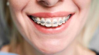 Брекеты и элайнеры могут влиять на мозговую активность — ученые
