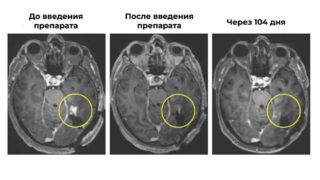 Произошел прорыв в лечении агрессивной формы рака мозга