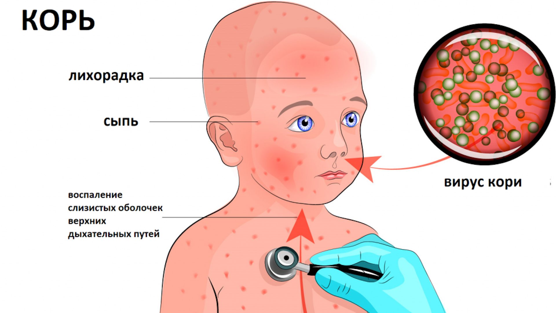 В Жамбылской области растет число заболевших корью из-за непривитых детей